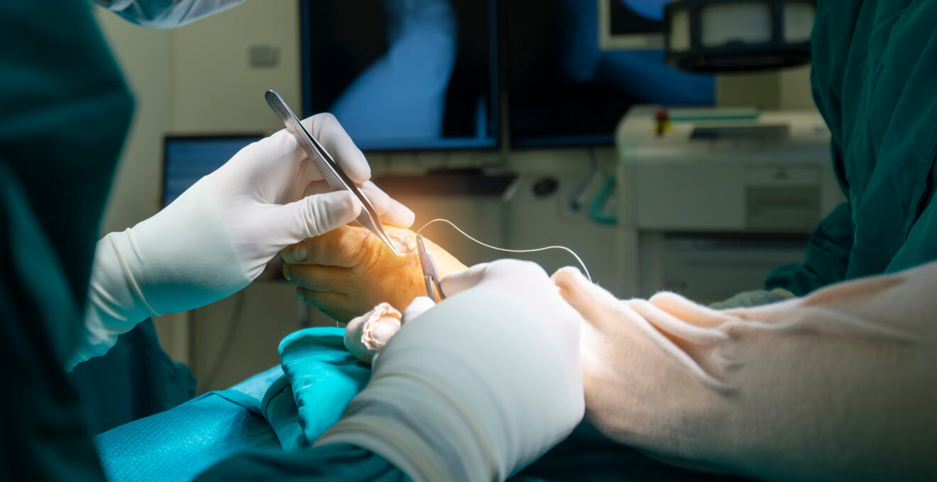 Chirurgie de l’hallux valgus